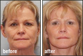 Facelift Results